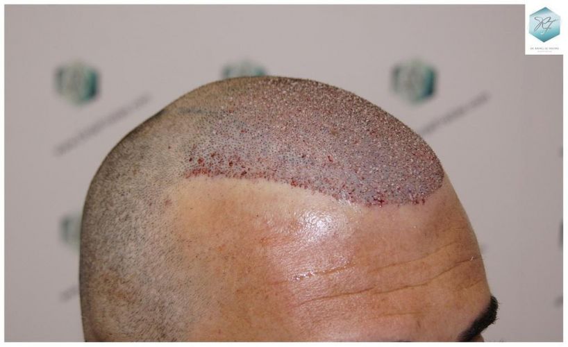 Injerto Capilar Técnica FUE 6230 Grafts (14226 Pelos) 18 trasplante de pelo valencia