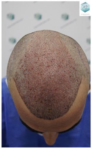 Injerto Capilar Técnica FUE 6230 Grafts (14226 Pelos) 13 trasplante de pelo valencia