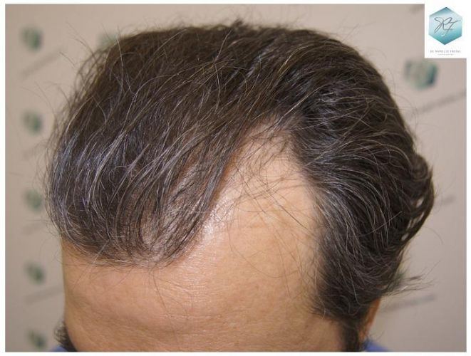 Injerto Capilar Técnica FUE 3302 Grafts (7603 Pelos) 4 implante de pelo