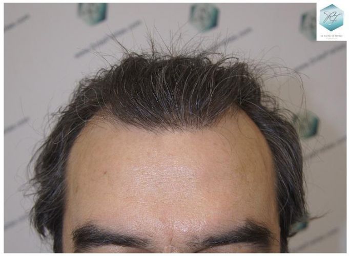 ANTES DEL TRASPLANTE CAPILAR implante de pelo
