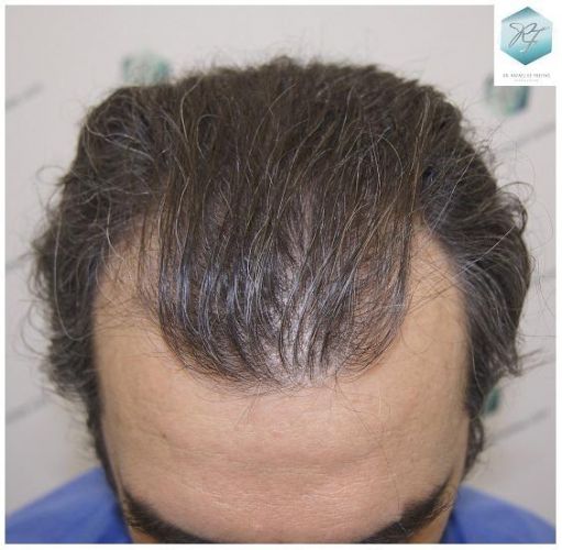 Injerto Capilar Técnica FUE 3302 Grafts (7603 Pelos) 2 implante de pelo