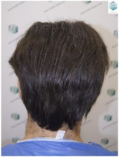 Injerto Capilar Técnica FUE 3302 Grafts (7603 Pelos) 39 implante de pelo