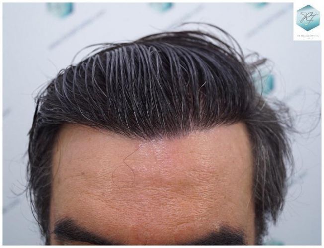 Injerto Capilar Técnica FUE 3302 Grafts (7603 Pelos) 18 clinica de injerto capilar españa