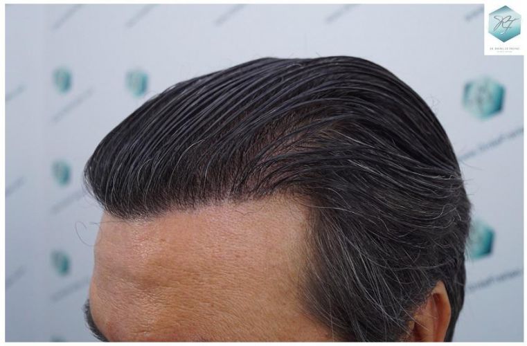 Injerto Capilar Técnica FUE 3302 Grafts (7603 Pelos) 37 clinica de injerto capilar españa