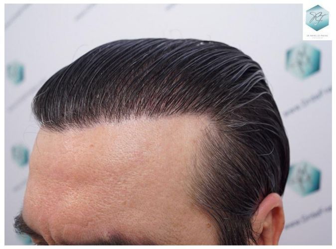 Injerto Capilar Técnica FUE 3302 Grafts (7603 Pelos) 36 clinica de injerto capilar españa