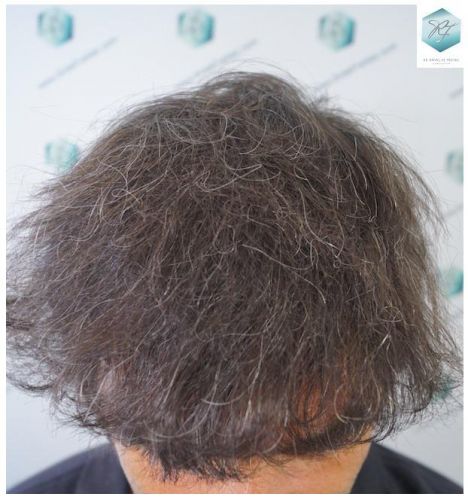 Injerto Capilar Técnica FUE 3302 Grafts (7603 Pelos) 1 clinica de injerto capilar españa