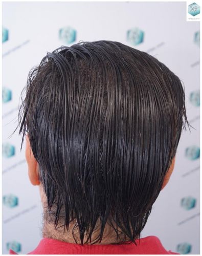 Injerto Capilar Técnica FUE 3302 Grafts (7603 Pelos) 38 clinica de injerto capilar españa