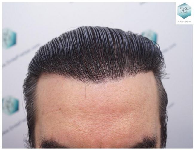 Injerto Capilar Técnica FUE 3302 Grafts (7603 Pelos) 35 clinica de injerto capilar españa