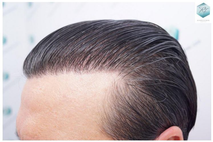 Injerto Capilar Técnica FUE 3302 Grafts (7603 Pelos) 34 clinica de injerto capilar españa