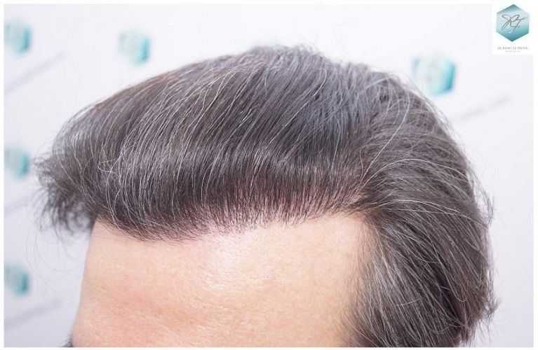 Injerto Capilar Técnica FUE 3302 Grafts (7603 Pelos) 24 clinica de injerto capilar españa