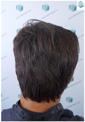 Injerto Capilar Técnica FUE 3302 Grafts (7603 Pelos) 33 clinica de injerto capilar españa
