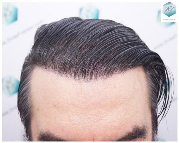 Injerto Capilar Técnica FUE 3302 Grafts (7603 Pelos) 32 injerto de pelo