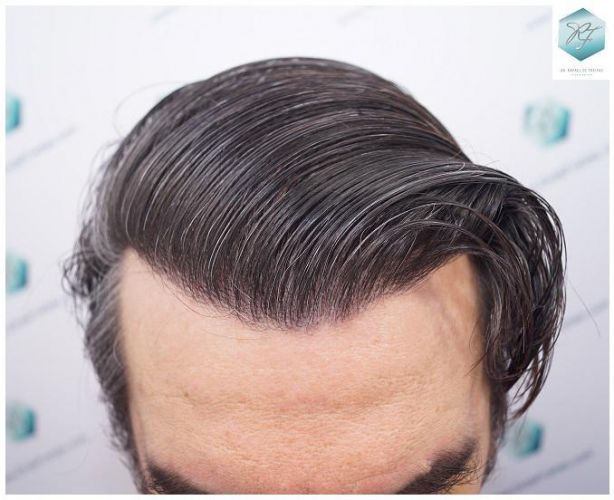 Injerto Capilar Técnica FUE 3302 Grafts (7603 Pelos) 31 injerto de pelo