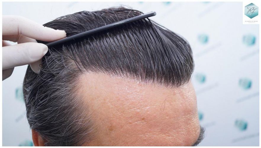 Injerto Capilar Técnica FUE 3302 Grafts (7603 Pelos) 21 clinica de injerto capilar españa