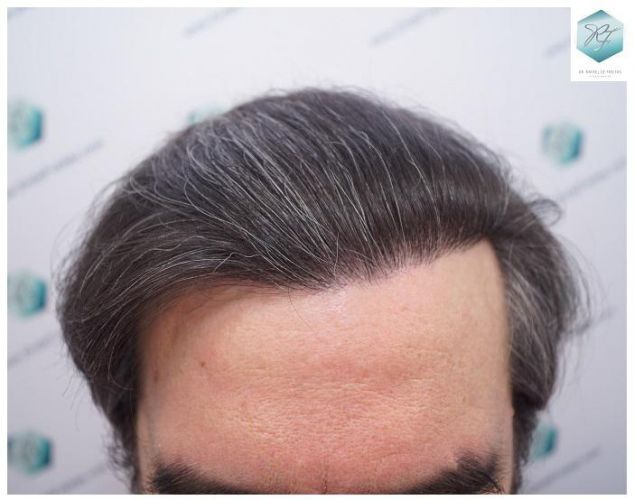 Injerto Capilar Técnica FUE 3302 Grafts (7603 Pelos) 30 injerto de pelo