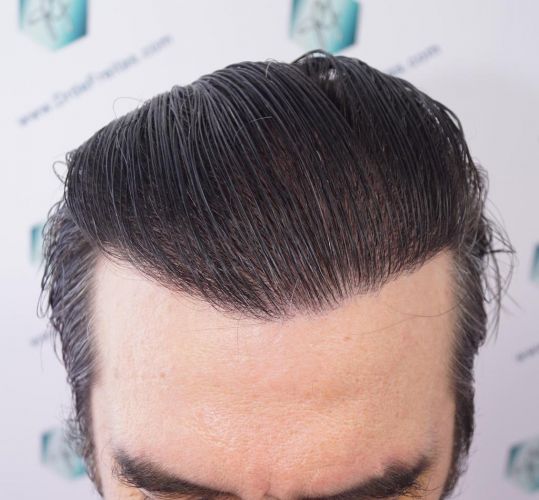Injerto Capilar Técnica FUE 3302 Grafts (7603 Pelos) 29 injerto de pelo
