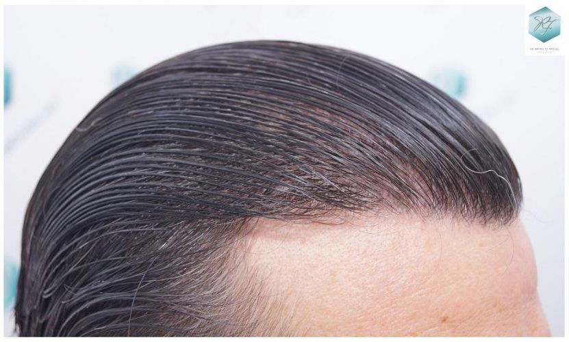 Injerto Capilar Técnica FUE 3302 Grafts (7603 Pelos) 20 injerto de pelo