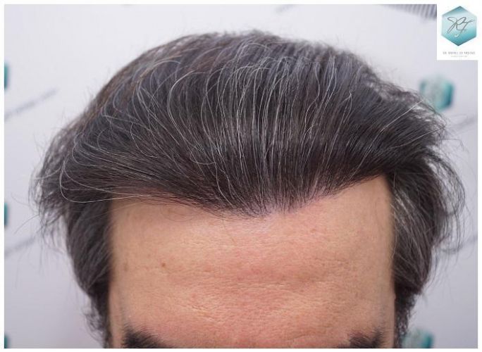 Injerto Capilar Técnica FUE 3302 Grafts (7603 Pelos) 17 injerto de pelo