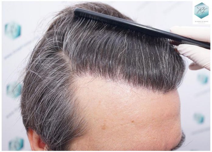 Injerto Capilar Técnica FUE 3302 Grafts (7603 Pelos) 19 injerto de pelo