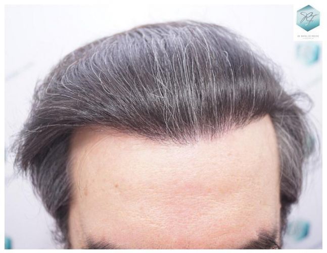 Injerto Capilar Técnica FUE 3302 Grafts (7603 Pelos) 15 injerto de pelo
