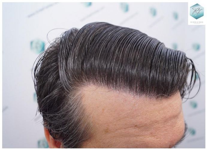 Injerto Capilar Técnica FUE 3302 Grafts (7603 Pelos) 27 clinica de injerto capilar españa