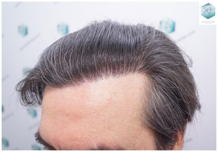 Injerto Capilar Técnica FUE 3302 Grafts (7603 Pelos) 26 clinica de injerto capilar españa