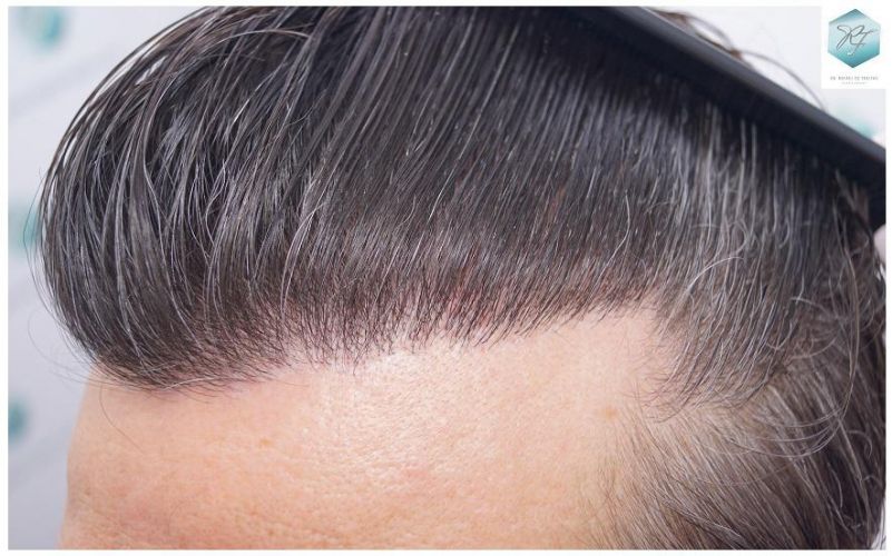 Injerto Capilar Técnica FUE 3302 Grafts (7603 Pelos) 25 clinica de injerto capilar españa