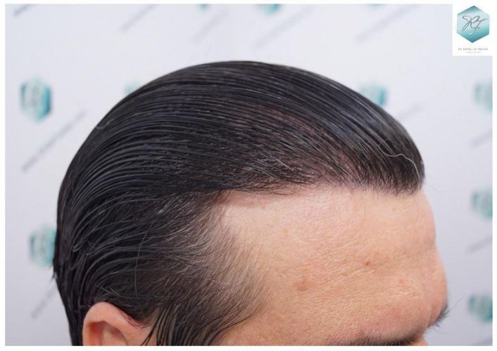 Injerto Capilar Técnica FUE 3302 Grafts (7603 Pelos) 28 clinica de injerto capilar españa