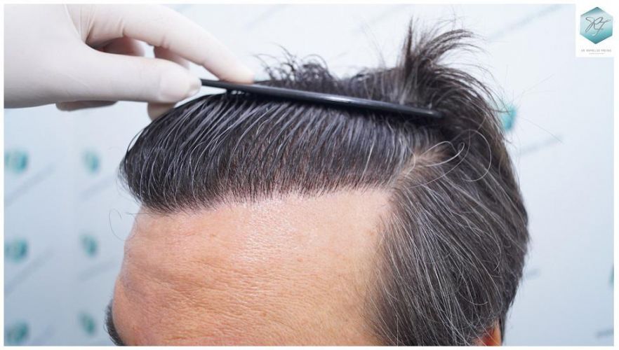 Injerto Capilar Técnica FUE 3302 Grafts (7603 Pelos) 23 clinica de injerto capilar españa