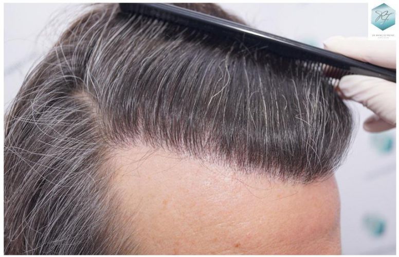 Injerto Capilar Técnica FUE 3302 Grafts (7603 Pelos) 22 clinica de injerto capilar españa