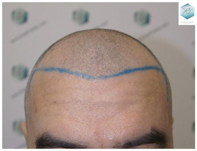 Injerto Capilar Técnica FUE 3302 Grafts (7603 Pelos) 9 implante de pelo
