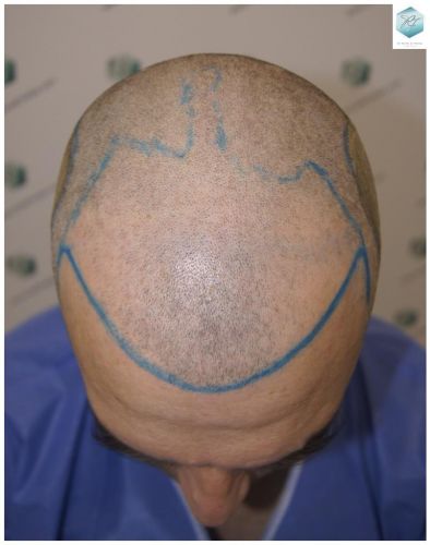 Injerto Capilar Técnica FUE 3302 Grafts (7603 Pelos) 10 clinica de injerto capilar españa