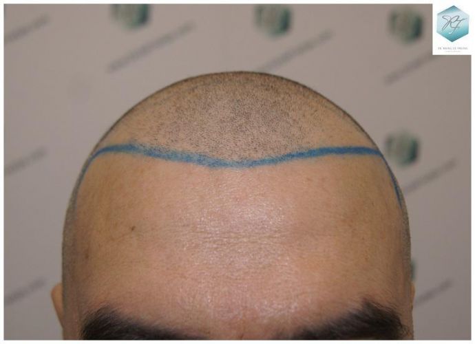 Injerto Capilar Técnica FUE 3302 Grafts (7603 Pelos) 8 clinica de injerto capilar españa