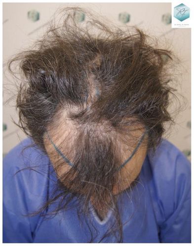 Injerto Capilar Técnica FUE 3302 Grafts (7603 Pelos) 5 clinica de injerto capilar españa