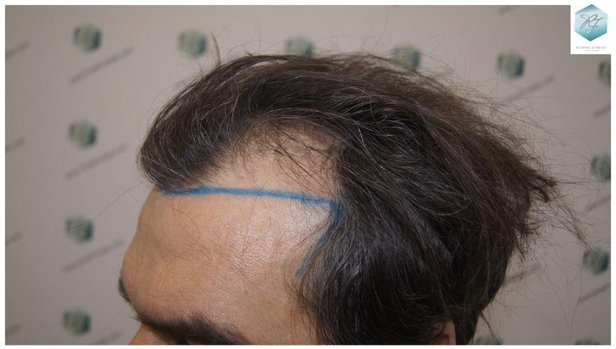 Injerto Capilar Técnica FUE 3302 Grafts (7603 Pelos) 7 clinica de injerto capilar españa
