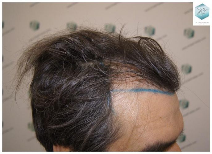 Injerto Capilar Técnica FUE 3302 Grafts (7603 Pelos) 6 clinica de injerto capilar españa