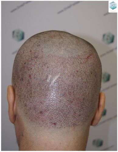 Injerto Capilar Técnica FUE 3302 Grafts (7603 Pelos) 14 clinica de injerto capilar españa
