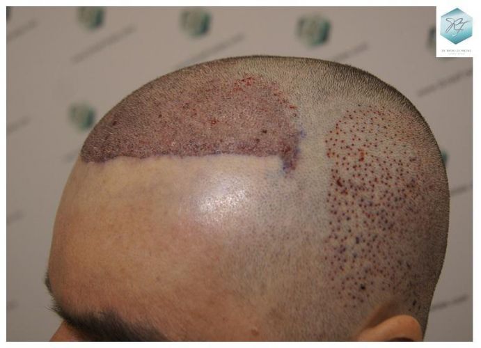 Injerto Capilar Técnica FUE 3302 Grafts (7603 Pelos) 13 clinica de injerto capilar españa