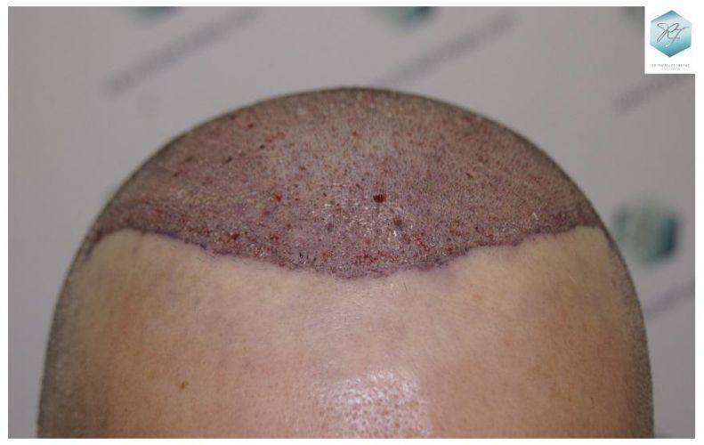 Injerto Capilar Técnica FUE 3302 Grafts (7603 Pelos) 11 clinica de injerto capilar españa