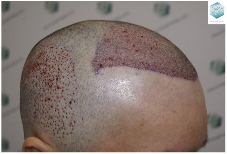 Injerto Capilar Técnica FUE 3302 Grafts (7603 Pelos) 12 clinica de injerto capilar españa