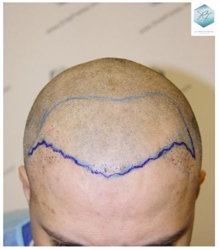 trasplante de pelo valencia