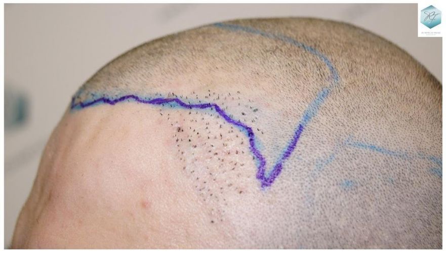 trasplante de pelo valencia