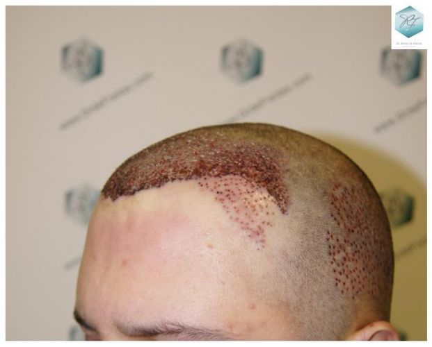 clinica de injerto capilar