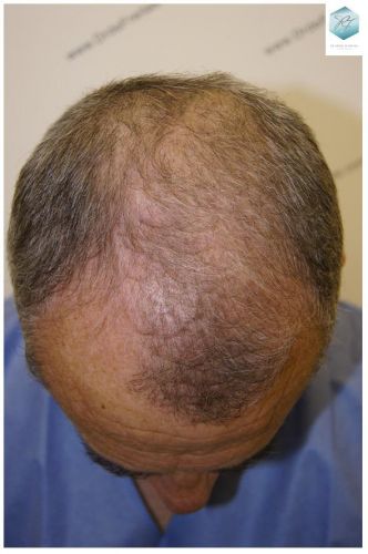Injerto Capilar Técnica FUE 2911 Grafts (Pelos 6191) 2 antes de trasplante capilar