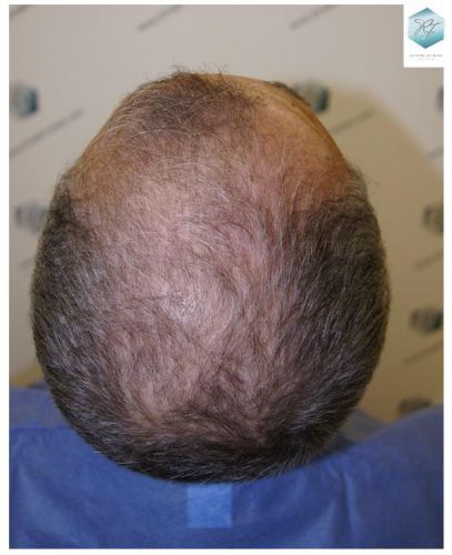 Injerto Capilar Técnica FUE 2911 Grafts (Pelos 6191) 3 antes de trasplante capilar