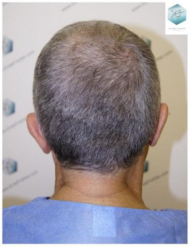 Injerto Capilar Técnica FUE 2911 Grafts (Pelos 6191) 22 antes de trasplante capilar
