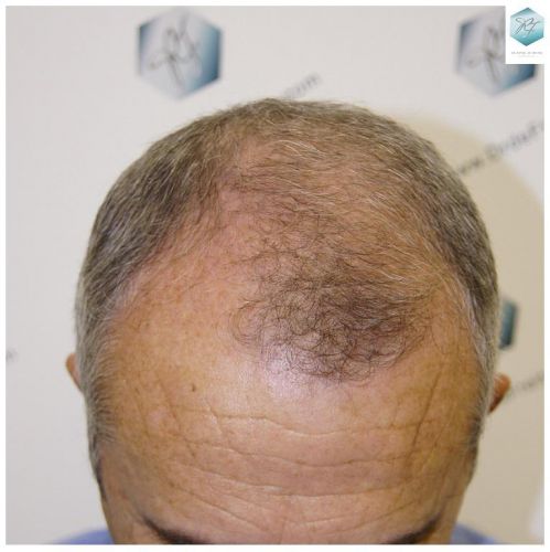 Injerto Capilar Técnica FUE 2911 Grafts (Pelos 6191) 1 antes de trasplante capilar