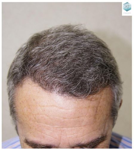 Injerto Capilar Técnica FUE 2911 Grafts (Pelos 6191) 17 trasplante pelo canoso