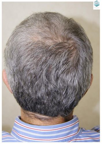 Injerto Capilar Técnica FUE 2911 Grafts (Pelos 6191) 21 trasplante pelo canoso