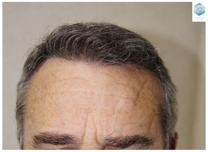 Injerto Capilar Técnica FUE 2911 Grafts (Pelos 6191) 16 trasplante pelo canoso